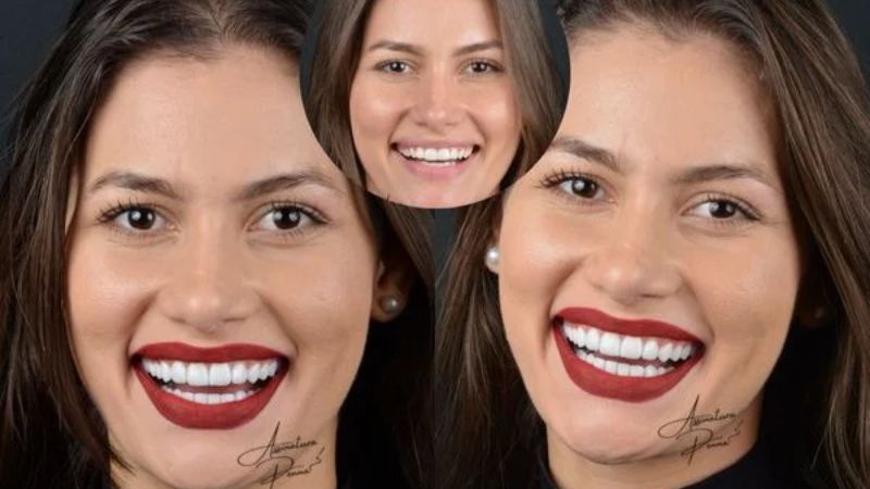 Namorada de Amado Batista investe R$ 150 mil em transformação dental antes do casamento