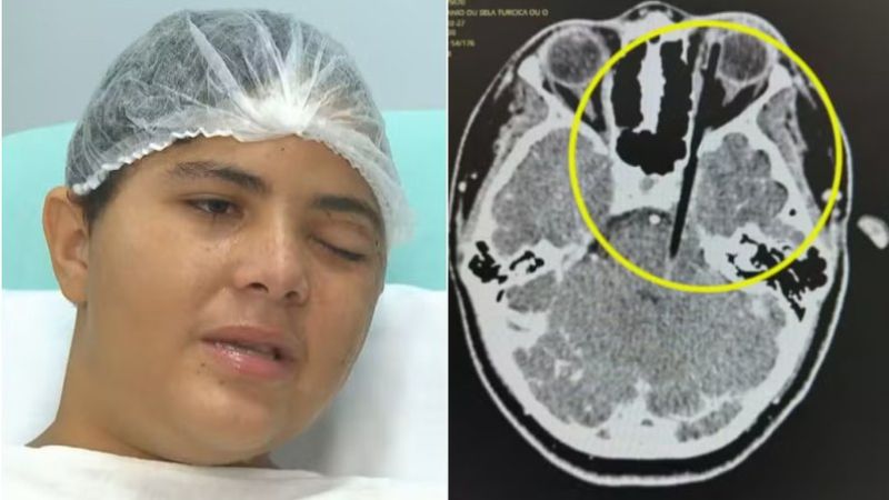 Adolescente ferido com palito de churrasco no olho durante briga em ônibus no Rio de Janeiro