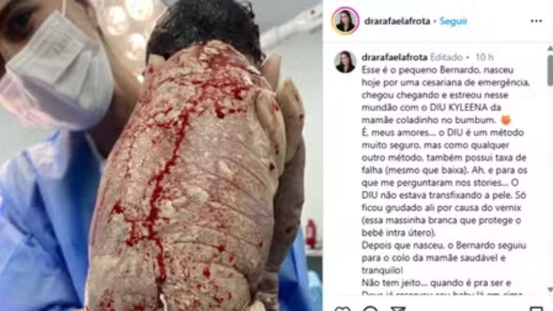 Mulher engravida com DIU e bebê nasce com dispositivo grudado nas costas no DF