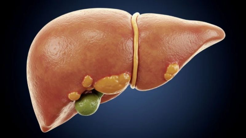 Gordura no fígado: riscos, sintomas e estratégias de prevenção