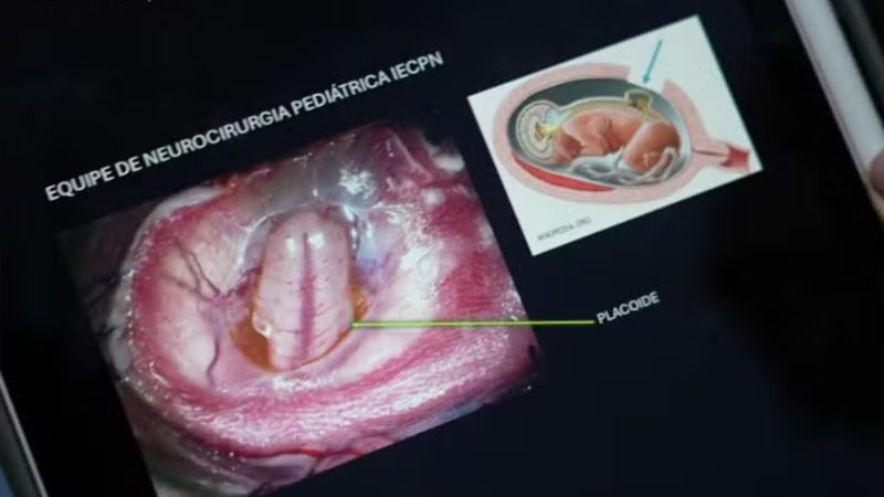 Cirurgia inédita pelo SUS corrige má formação na coluna de bebê ainda no útero