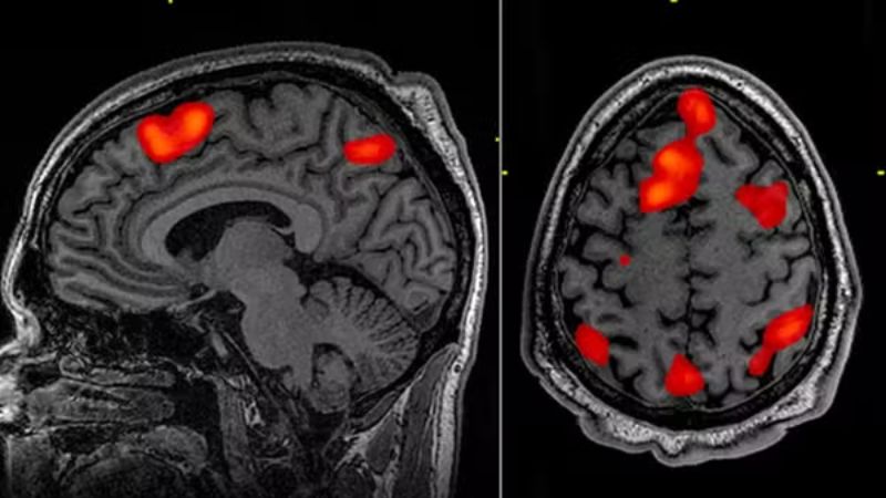 Terapia genética reduz em 75% progressão da doença de Huntington em estudo clínico histórico