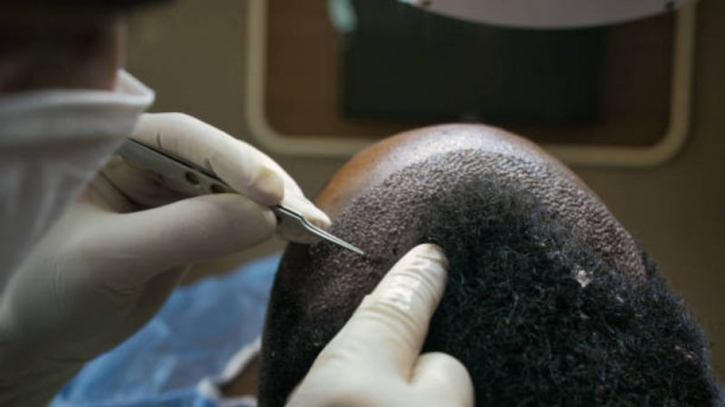 Turquia vira destino de luxo para transplantes capilares e atraiu mais de 1 milhão de pacientes em 2024