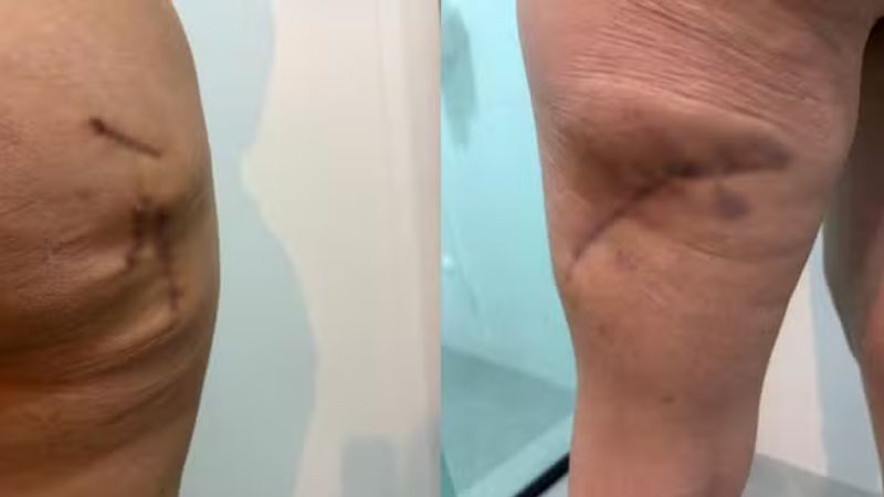 Modelo denuncia necrose após procedimento estético em SC; clínica é interditada e polícia investiga