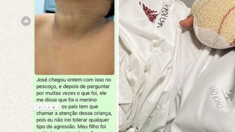 Criança brasileira tem dedos decepados em escola de Portugal; mãe denuncia bullying e professora minimiza caso