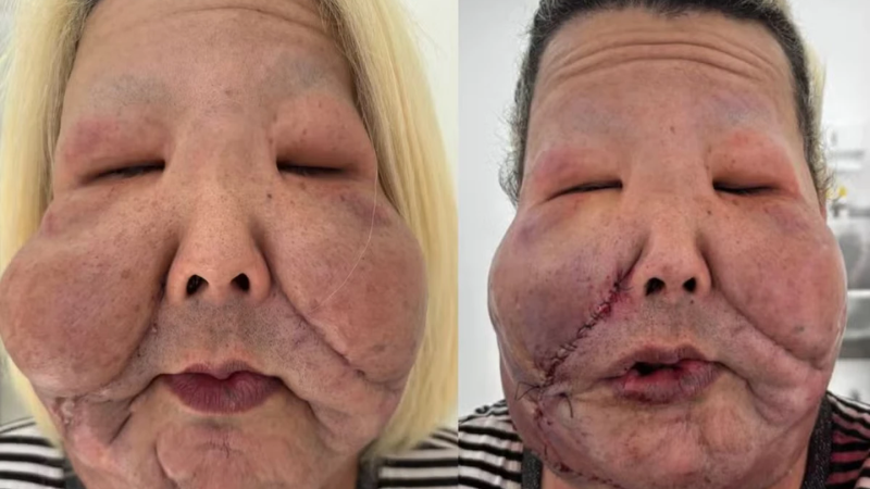 Juju do Pix passa por nova cirurgia para retirada de óleo mineral enrijecido