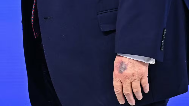 Hematoma na mão de Trump volta a gerar especulações em Davos