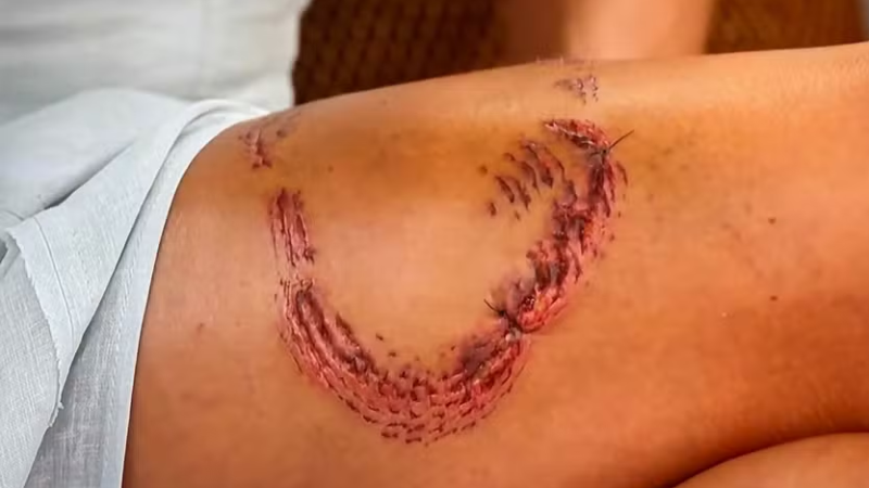 Turista mostra marcas de mordida de tubarão em Noronha e relata dor intensa