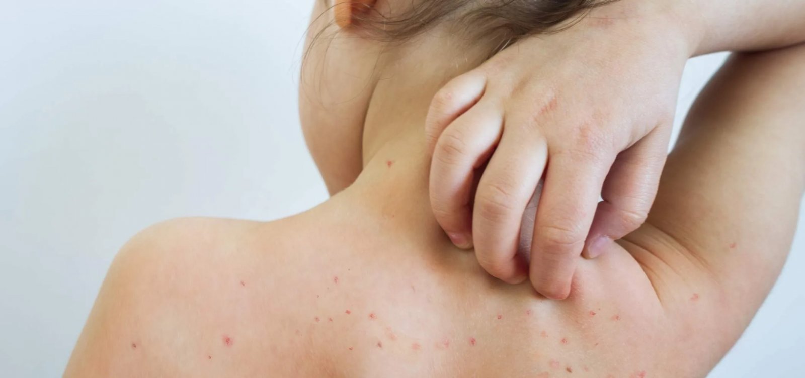 Casos de sarampo disparam nas Américas e crescem 32 vezes em um ano; Brasil monitora cenário