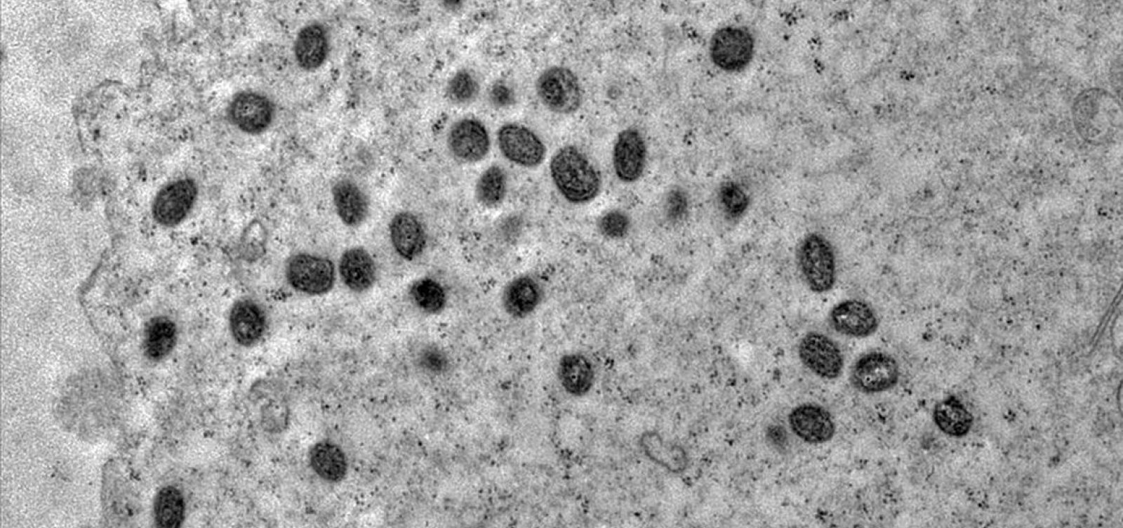 Brasil confirma 81 casos de mpox em 2026; maioria está em São Paulo