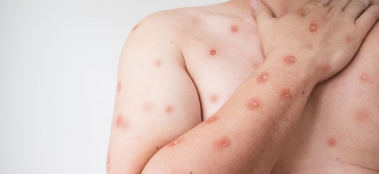 Porto Alegre registra primeiro caso de Mpox em 2026 e reforça medidas de prevenção para o Carnaval
