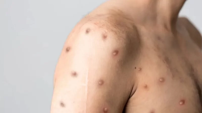 Ministério da Saúde confirma 55 casos de Mpox no país em 2026