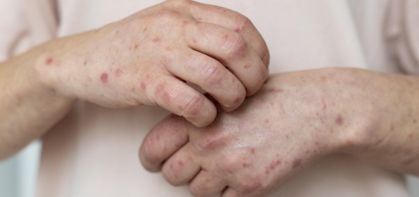 Brasil soma 149 casos de mpox em 2026; Bahia não registra infecções até o momento